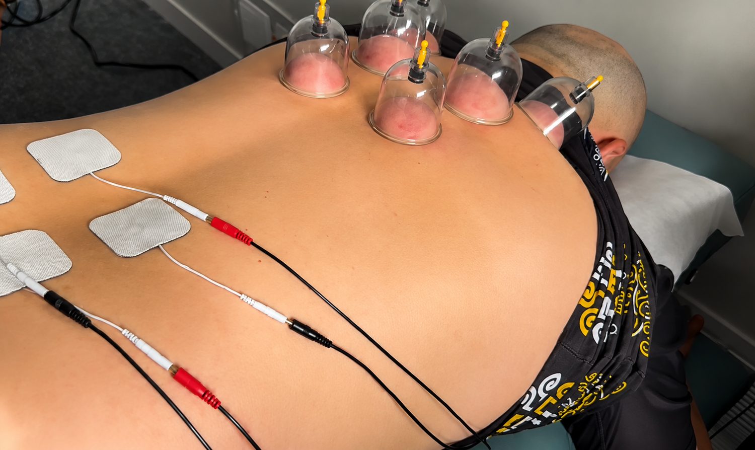 Cupping and electrical muscle stimulation (EMS) therapy on a patient's back at Chiroport